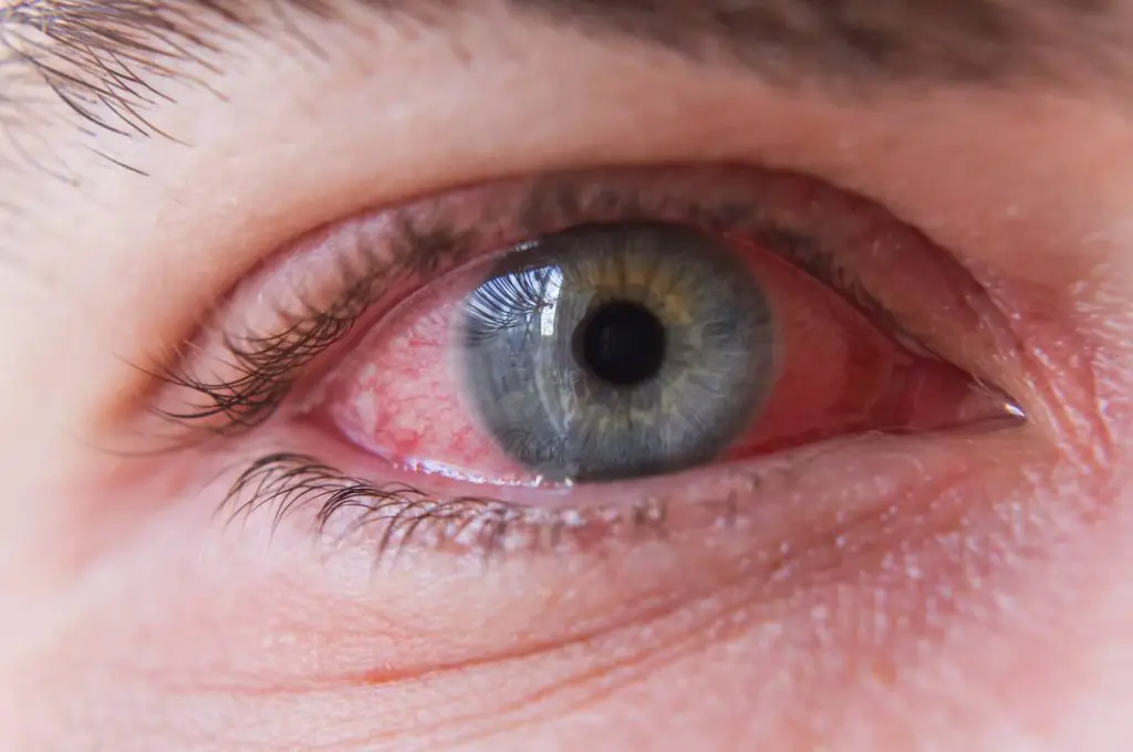 Eyes can burn and turn red in a swimming pool when the chemical balance is off.