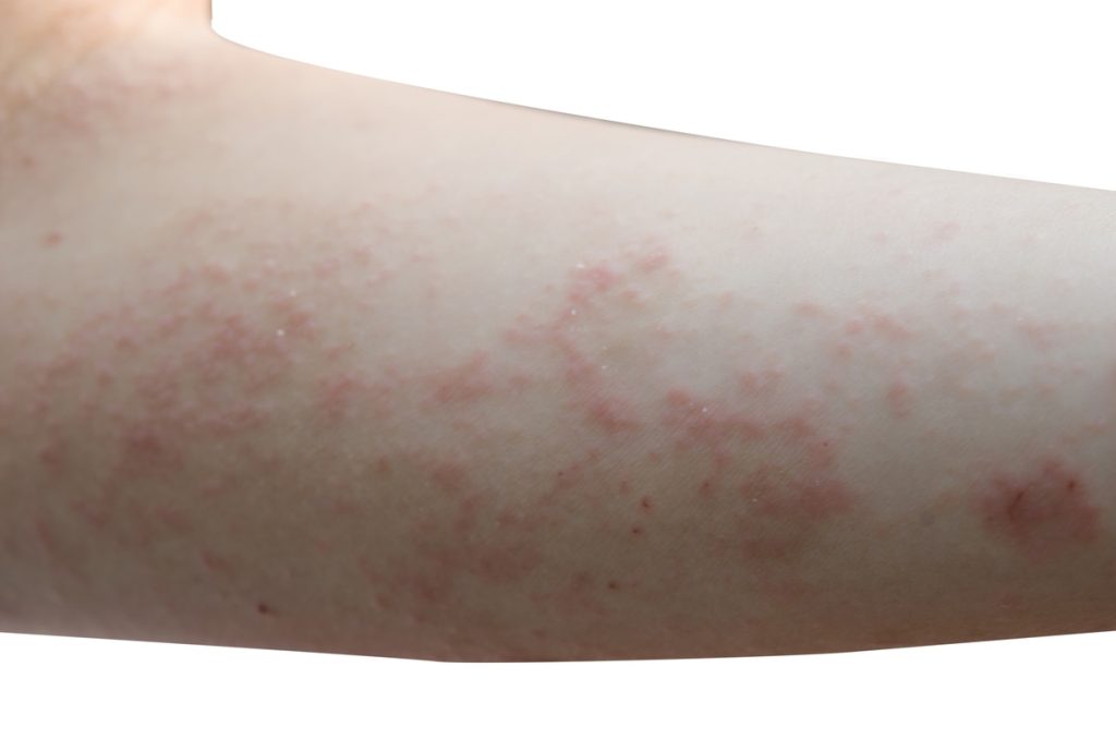 swimmers itch is caused by an allergic reaction to small parasites